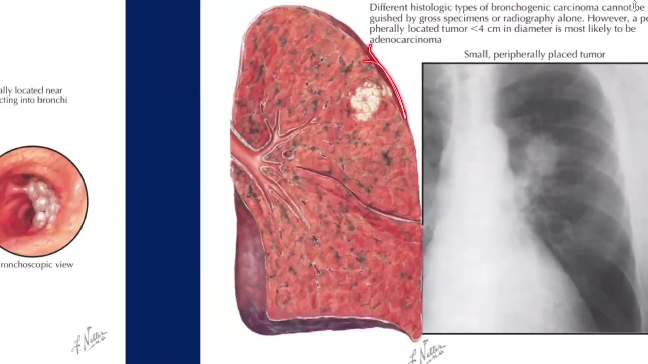 ca pulmon y tromboembolia pulmonar