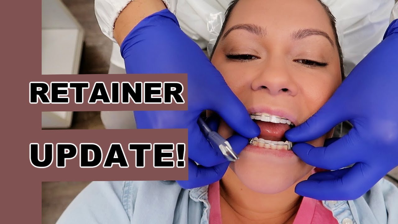 ADULT BRACES UPDATE | RETAINER EDITION | 1 MONTH AFTER BRACES | BINA RAE