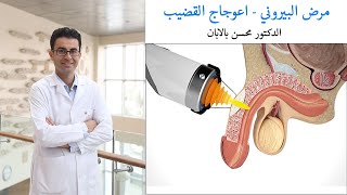 علاج مرض البيروني (اعوجاج القضيب) - الدكتور محسن بالابان