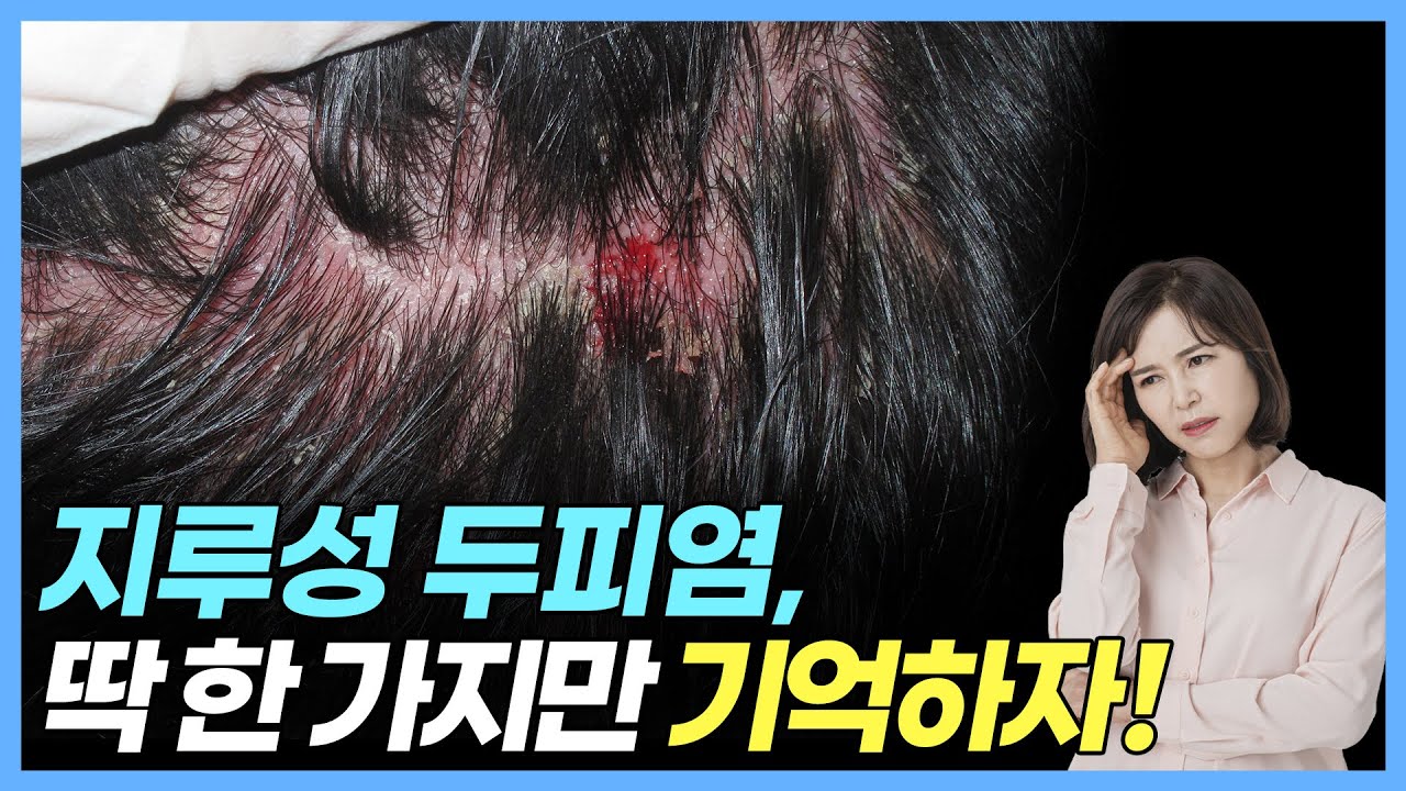 두피에서 피가나고 딱지가 앉는 지루성두피염, 치료 방법은? [Seborrheic Dermatitis] - YouTube