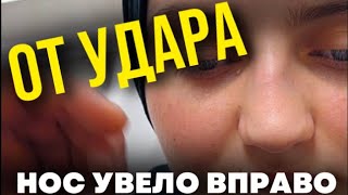 РИНОПЛАСТИКА НОСА С ГОРБИНКОЙ / СКОЛЬКО СТОИТ РИНОПЛАСТИКА