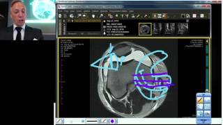 Knee MRI: Meniscus Tear - Part 1