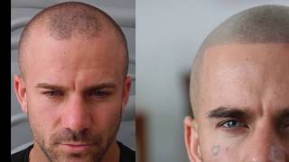 Amazing Scalp Micropigmentation Results and Testimonial | Skalptec Ltd | SMP Clinics UK & Europe