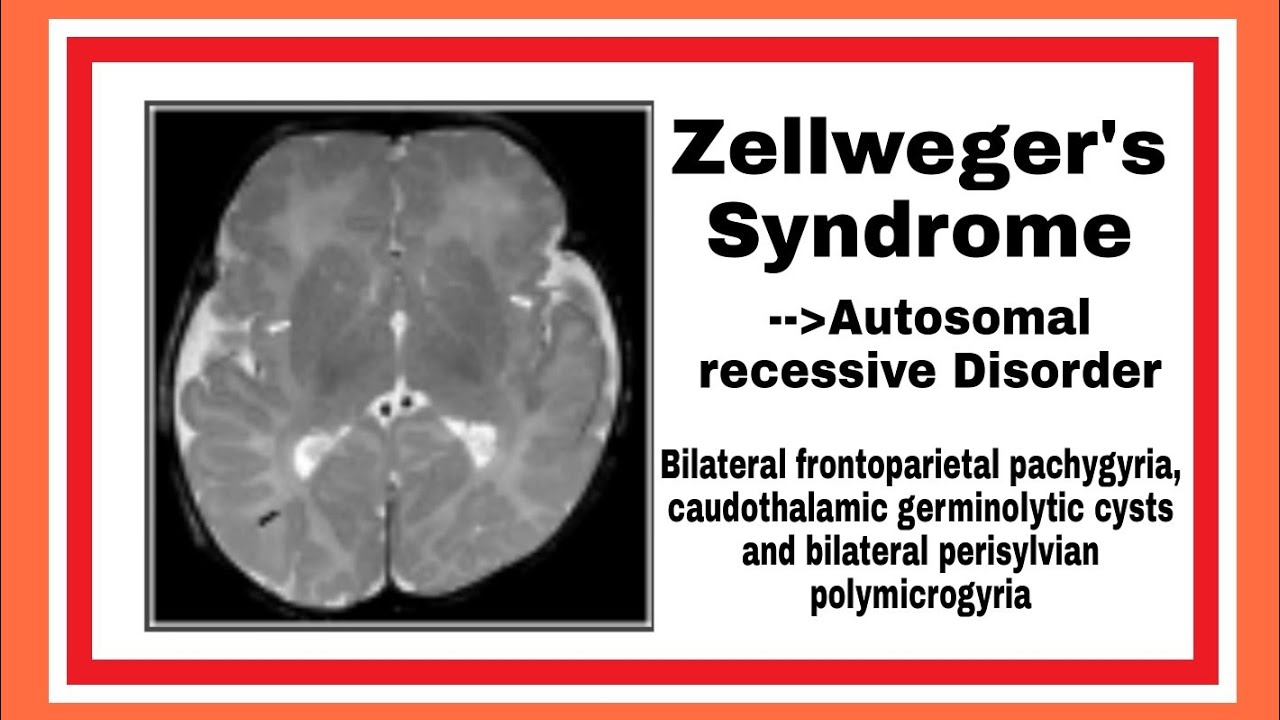 Zellweger's Syndrome YouTube