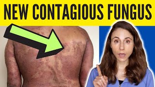 DRUG-RESISTANT CONTAGIOUS RINGWORM IN THE US 😱