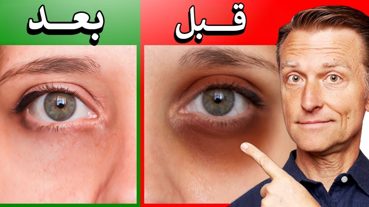 علاج السبب الحقيقي للسواد و الهالات تحت العين