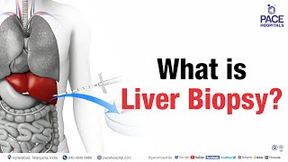 Liver Biopsy | What is Liver Biopsy? | #shortvideo #liverbiopsy
