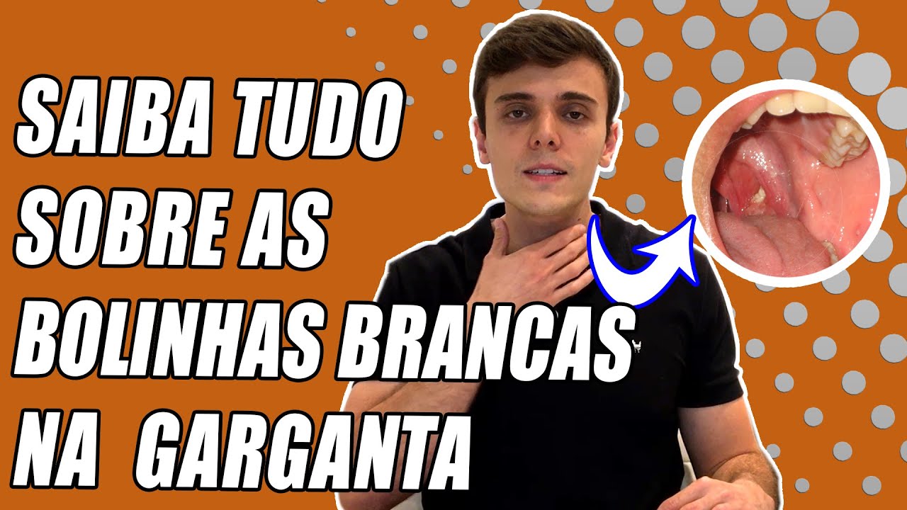 BOLINHA FEDIDA NA GARGANTA!! Cáseos, bolinhas brancas fedorentas