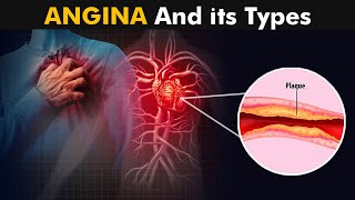 What is Angina And How it Works? | Types, Causes, Symptoms and treatment (3D Animation)