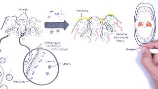 Tonsils - Clinical Anatomy (Palatine, lingual, tubal, adenoids)