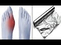 How To Treat Bunions Using Aluminum Foil!