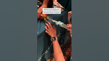 Thumbnail of #OBGYN shows first trimester abortion simulation #shorts #medicalstudent