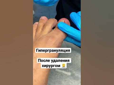 Вросшие ногти , гипергрануляция 🤦 что делать ? Опять к хирургу ? - YouTube