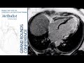 Heart Disease in Women: Coronary Artery Dissection, Postpartum Cardiomyopathy & STEMI(June 20, 2019)