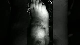 Twitching of top and outer right foot, cramp fasciculation syndrome.