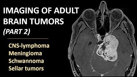 Imaging of brain tumors (part 2): CNS-lymphoma, meningioma, schwannoma and sellar tumors