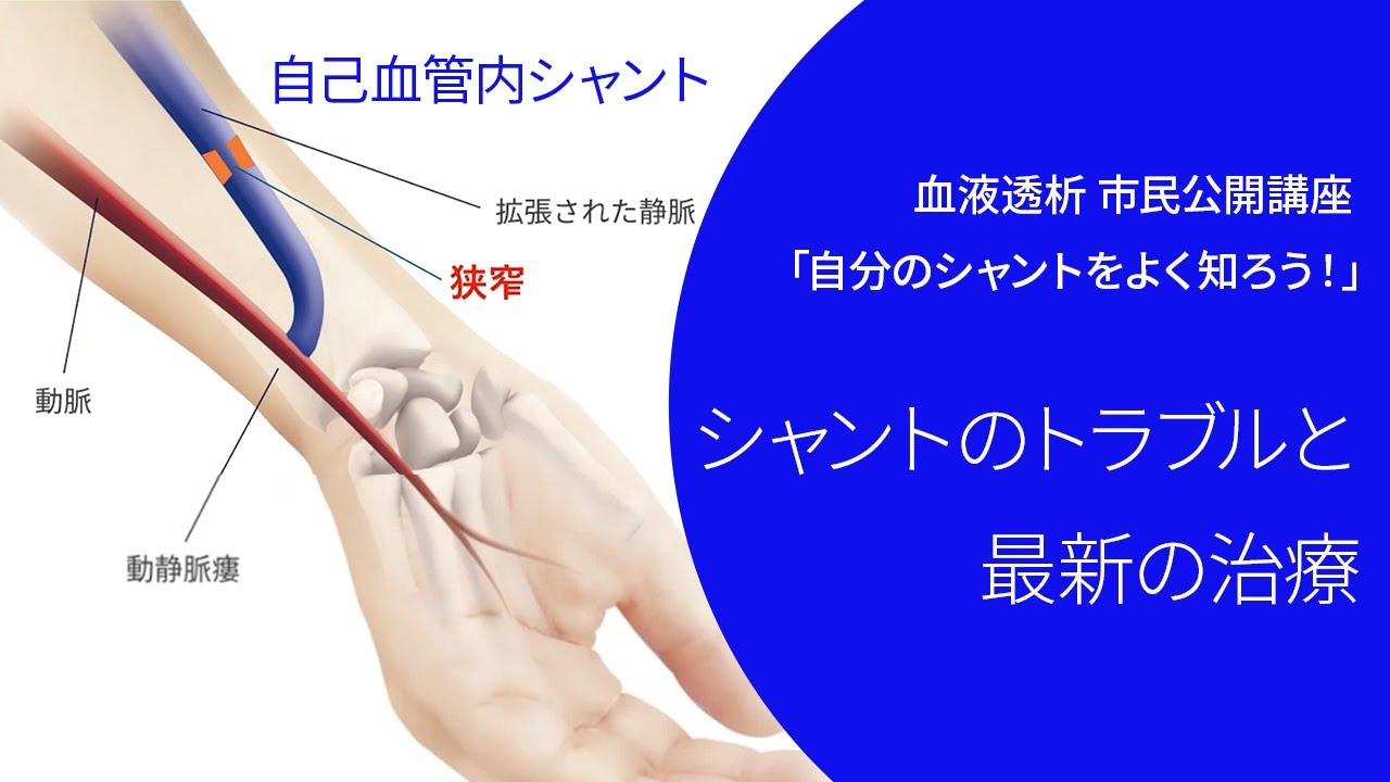 血液透析 シャントのトラブルと最新の治療【市民公開講座】 - YouTube