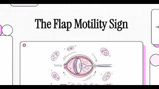Flap Motility Sign of Posterior Capsule Rupture