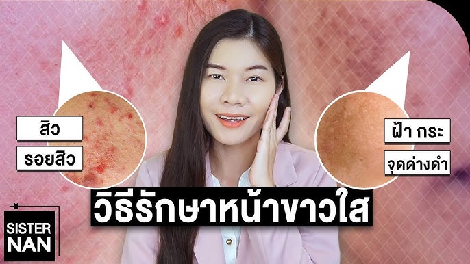 ลดรอยสิว หน้าไม่ใส หน้าหมองคล้ำ จุดด่างดำ รอยดำ รอยแดง Remove Dark Spots  And Marks | แนน Sister Nan - Youtube