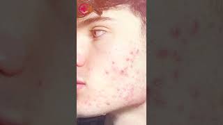 keracnyl Parte 2 #keracnyl #skincare #hidratacionfacial #mynextderma #acne