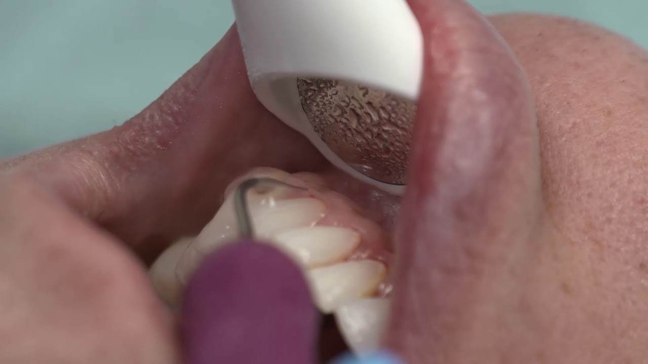 Purevac HVE System - Visibility, Illumination & Retraction | Dentsply Sirona