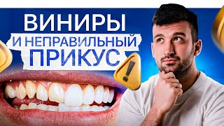 Зачем исправлять прикус перед установкой виниров? 5 ПРИЧИН