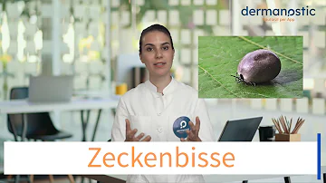 Welche Behandlung nach Zeckenbiss?