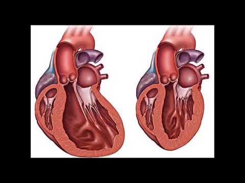 Video: Dilatierte Kardiomyopathie - Symptome, Behandlung, Formen, Stadien, Diagnose