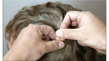 SCALP ACUPUNCTURE  Needle Techniques