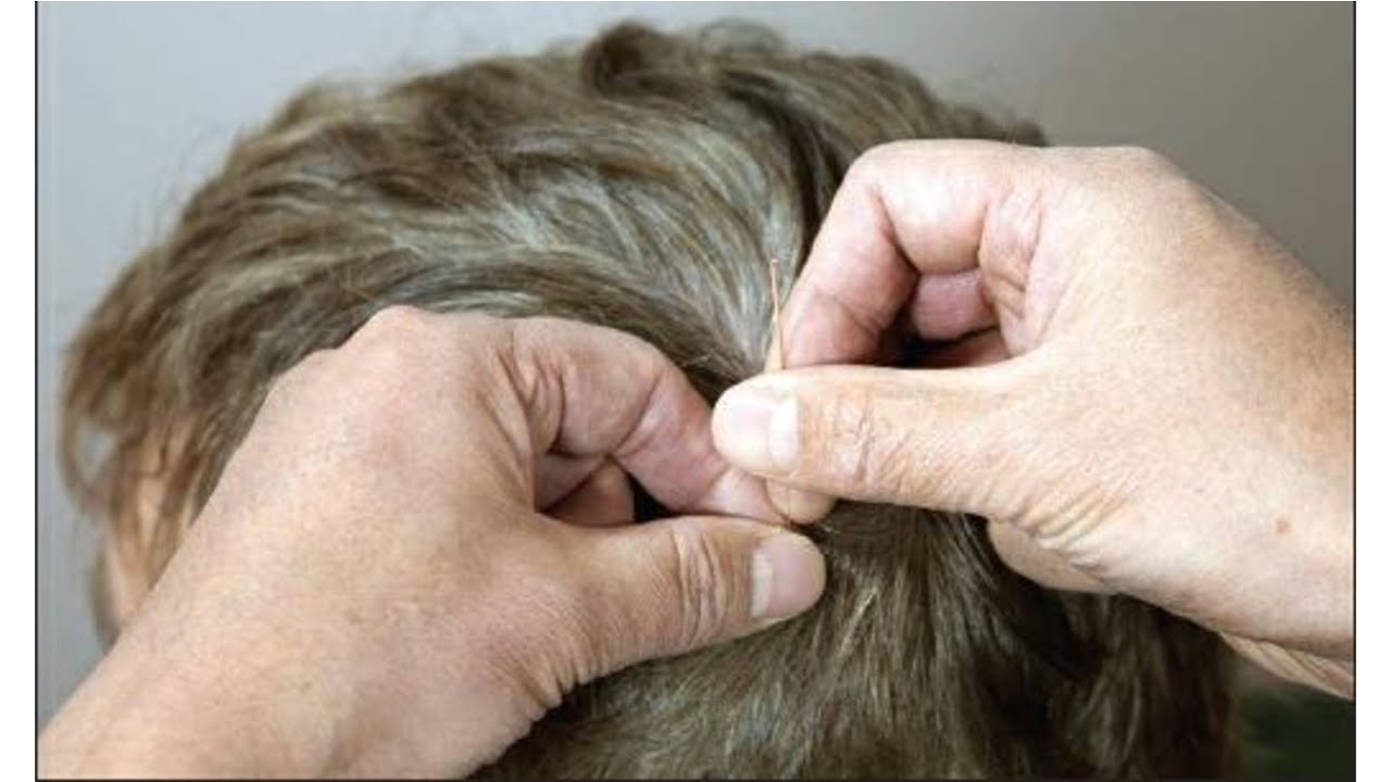 SCALP ACUPUNCTURE  Needle Techniques
