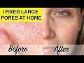 DIY LARGE PORES TREATMENT! At Home Glycolic Acid Peel Dramatically Reduces Pores &amp; Wrinkles