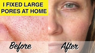 DIY LARGE PORES TREATMENT! At Home Glycolic Acid Peel Dramatically Reduces Pores & Wrinkles