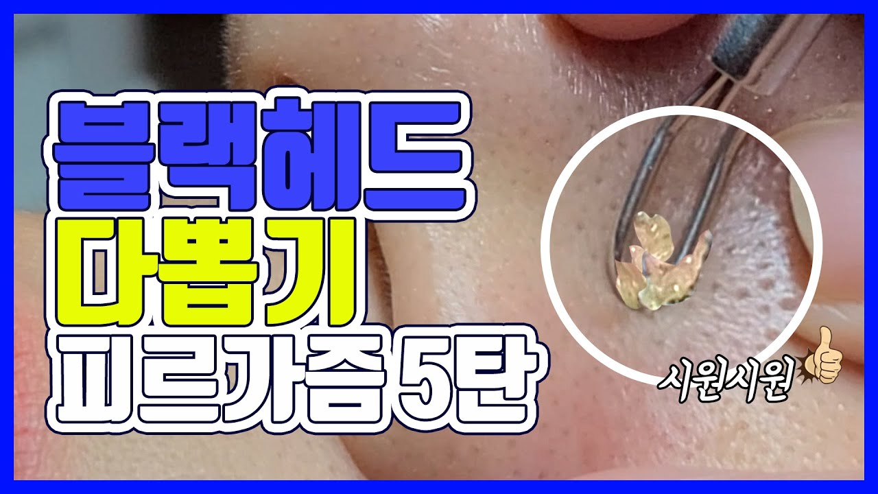 Eng) 블랙헤드 제거👃 코 피지 전체 다 뽑는 영상! Blackhead Removal,Sebum Extraction 피지 뽑기 ...