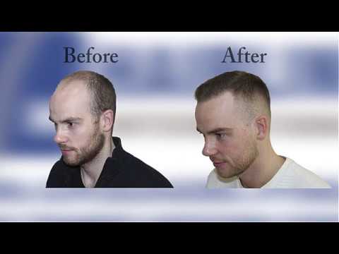 Hairline International - ერთერთი ჩვენი პაციენტი One of our patients(Rando Vares)