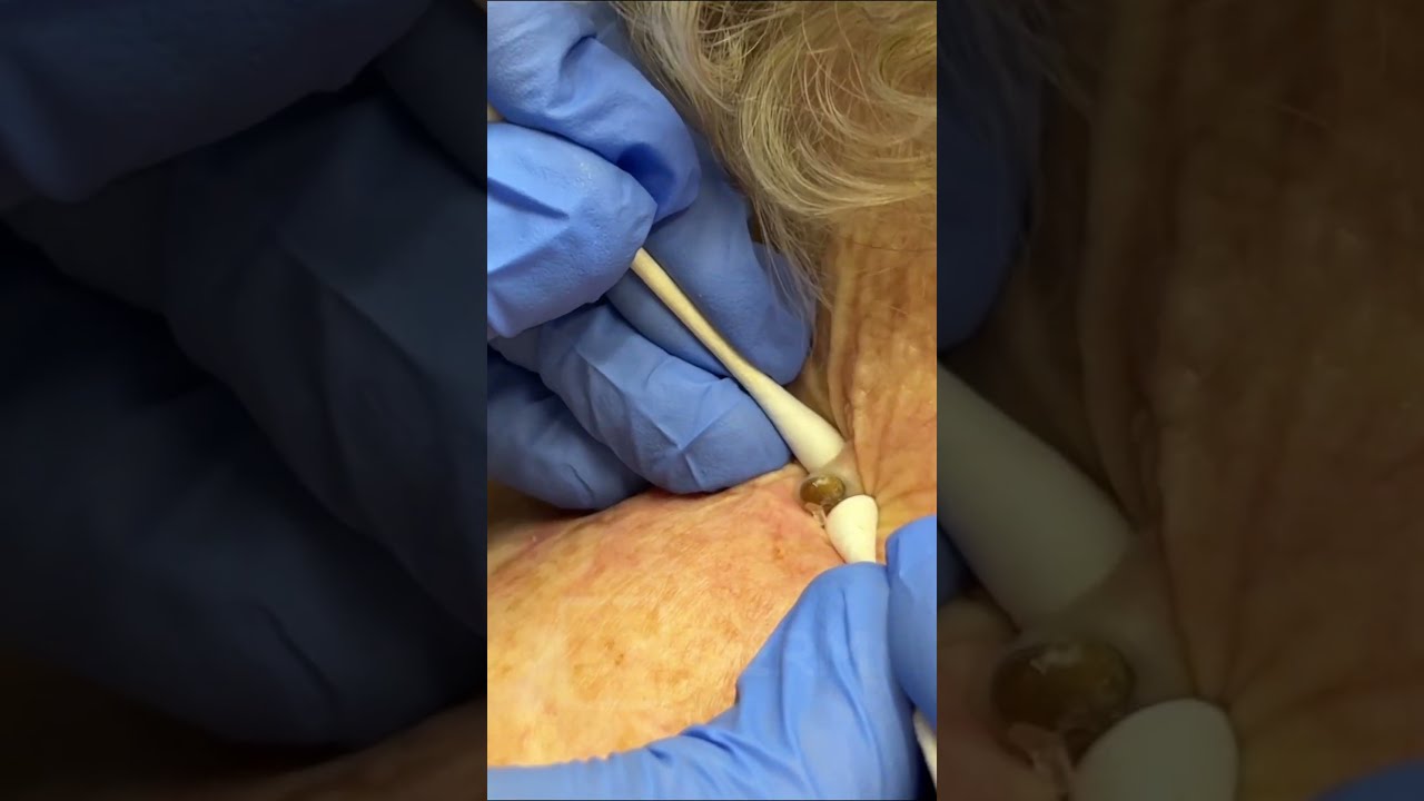 SATISFYING Pore Of Winer Removal Dr Derm
