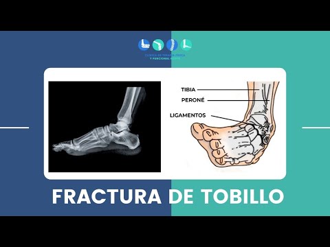 Fractura de Tobillo