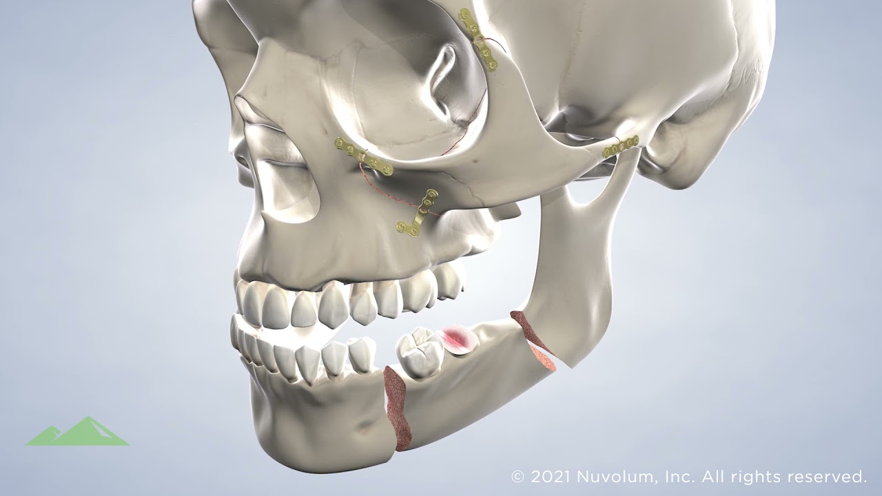 Facial Trauma at Utah Surgical Arts, Provo, UT