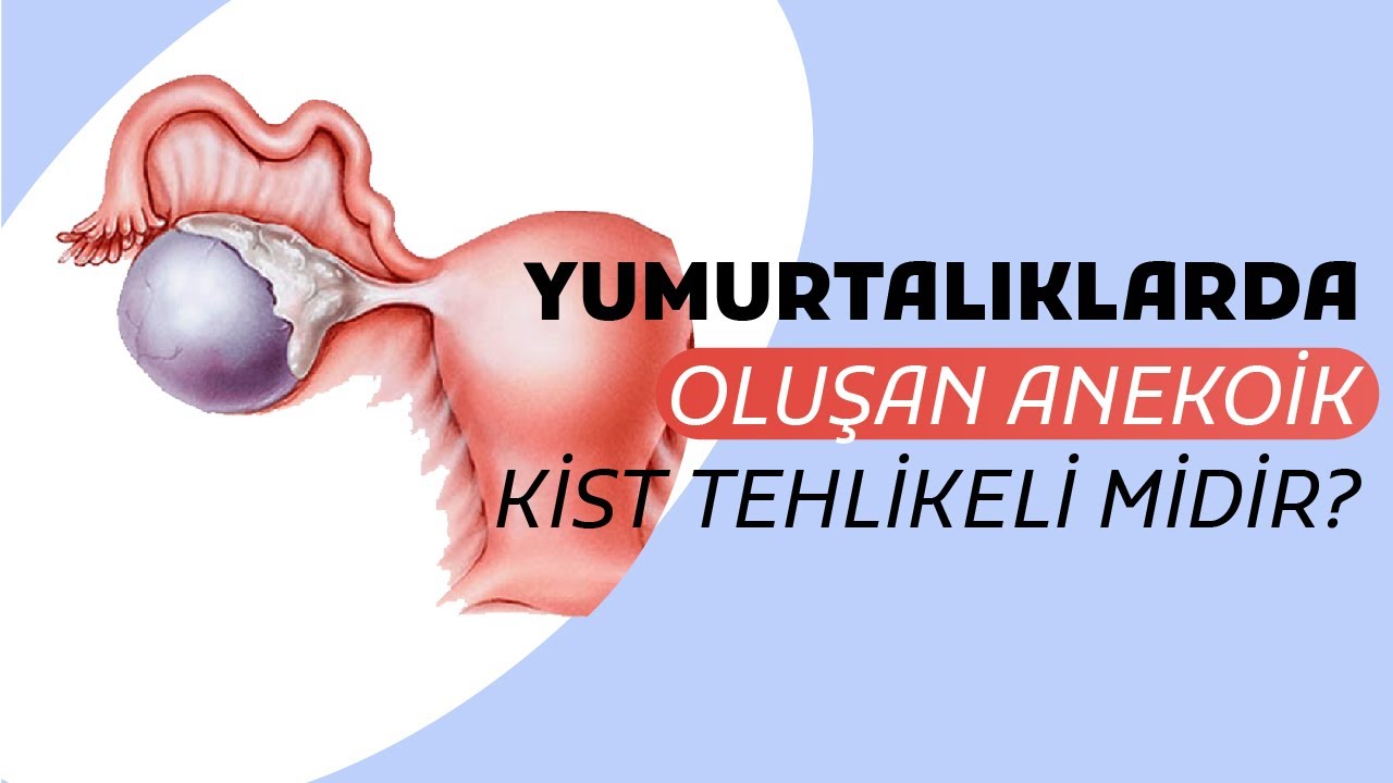 Anekoik Kist Nedir Yumurtal klarda Olu an Anekoik Kistler Tehlikeli anekoik-kist-nedir-yumurtal-klarda-olu-an-anekoik-kistler-tehlikeli