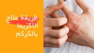 طريقة علاج الاكزيما بالكركم | علاج الاكزيما بالاعشاب | فائدة الكركم