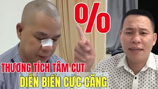 Xác định Thương Tích Tâm Cụt…Diễn Biến Cực Căng