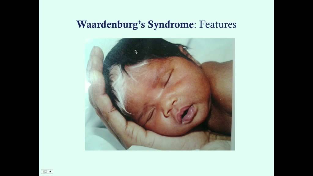 Waardenburg's Syndrome CRASH! Medical Review Series YouTube