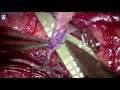 Extracranial-Intracranial Bypass for Moya Moya Disease