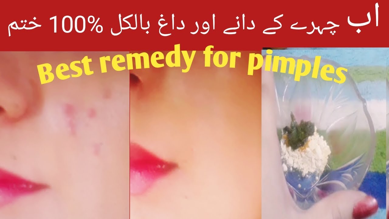How to Remove Pimples Fast | Best Acne treatment at home | remove Acne & Scars - YouTube
