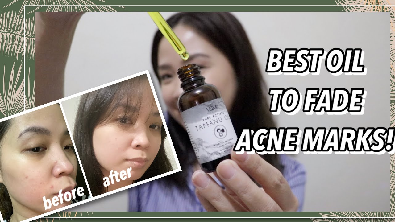 Newclothingdesigns How To Get Rid Of Pustule Acne