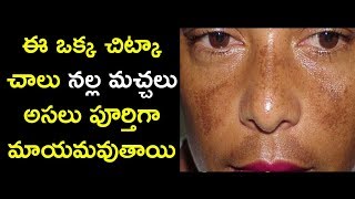 Follow These Tips to Completely Remove Dark Spots - Hyperpigmentation Remedies