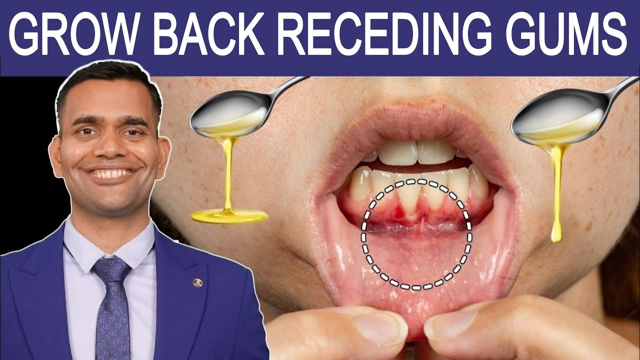 लगातार नीचे जाते मसूड़ों को बचाने का प्राकृतिक उपचार | Fix Receding Gums Naturally