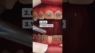 Broken Braces 😬! This is how we fix it 🦷🦷 #braces #orthodontics #shorts #broken #teeth