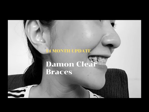 ไปหาหมอฟัน อัปเดตจัดฟันดามอนมา 14 เดือน | ไม่ได้ขูดหินปูน |  14 MONTH UPDATE | Damon Clear Braces