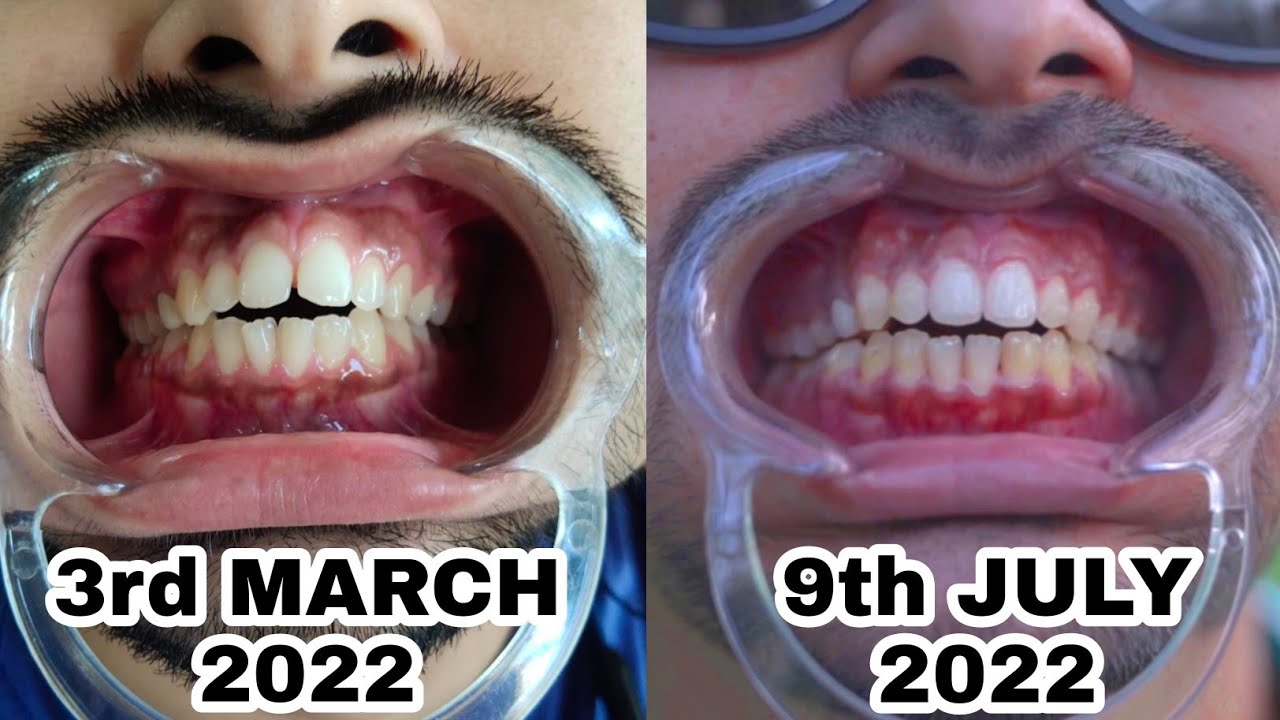 toothsi-aligners-honest-review-youtube