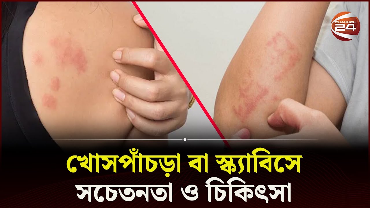 Scabies Health Tips scabies-health-tips